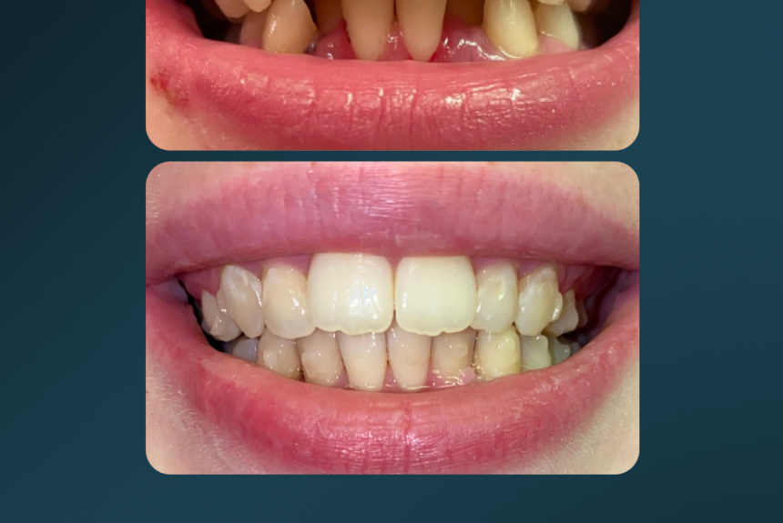 Mascherine Invisibile - Estetica e Sorriso