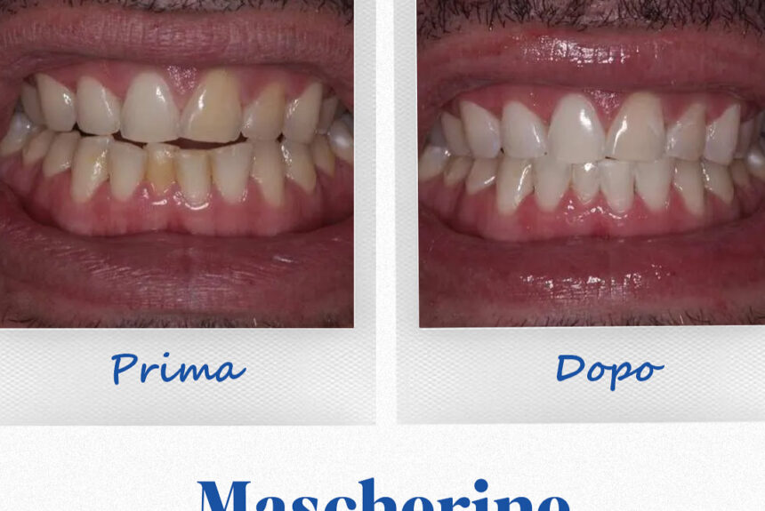 Mascherine Invisibile - Estetica e Sorriso