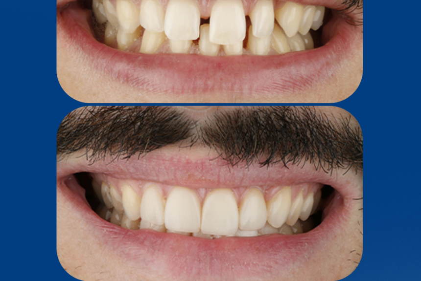 Mascherine Invisibile - Estetica e Sorriso