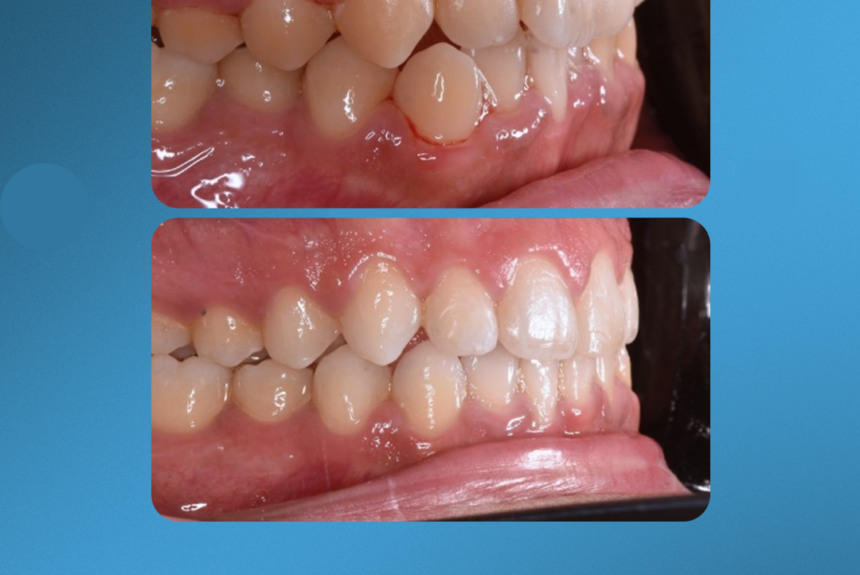 Mascherine Invisibile - Estetica e Sorriso