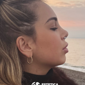 Rinoplastica - Estetica e Sorriso