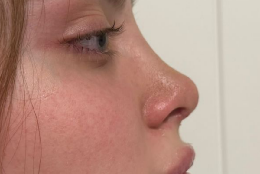 Rinoplastica - Estetica e Sorriso