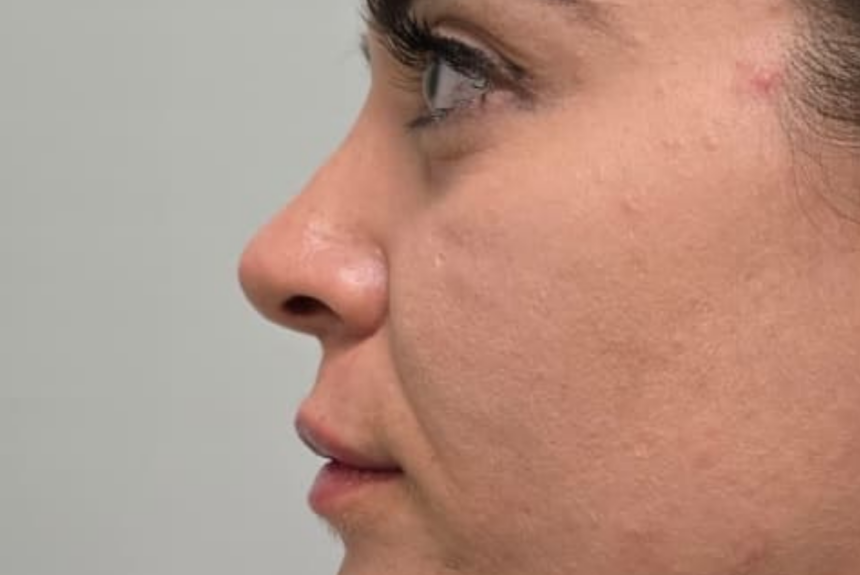 Rinoplastica - Estetica e Sorriso