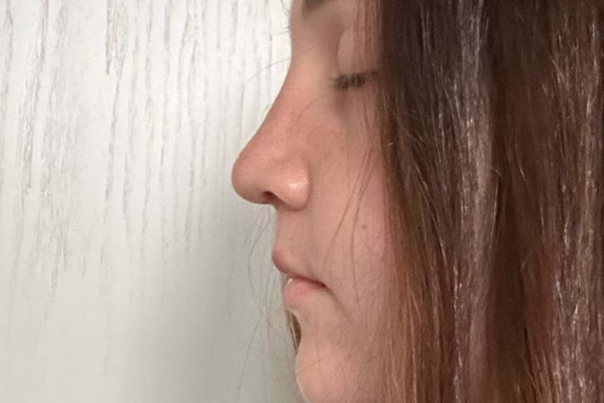 Rinoplastica - Estetica e Sorriso