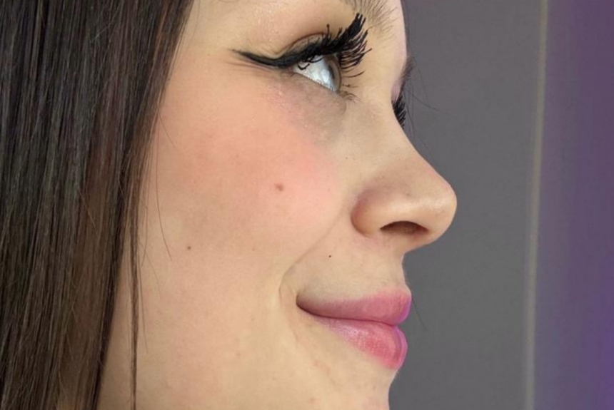 Rinoplastica - Estetica e Sorriso