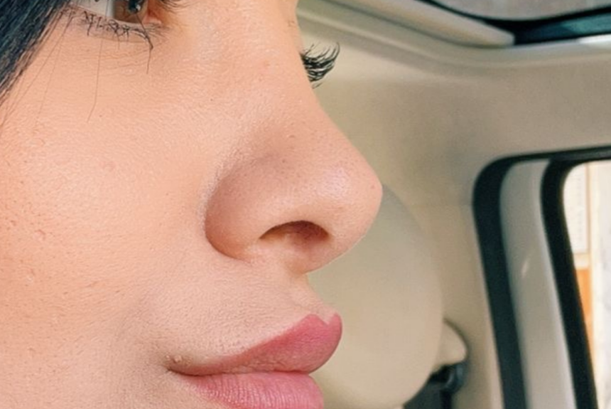 Rinoplastica - Estetica e Sorriso