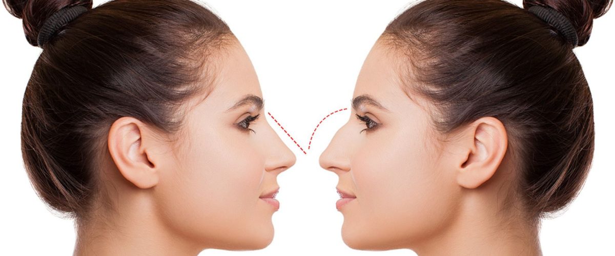 Estetica e Sorriso "Rinoplastica in Albania"