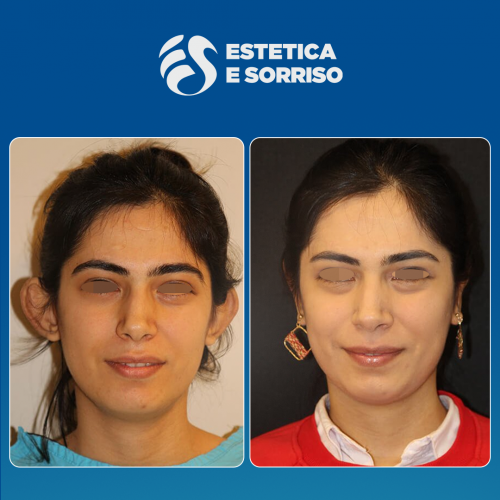 Estetica e Sorriso - Otoplastica (Gallery)