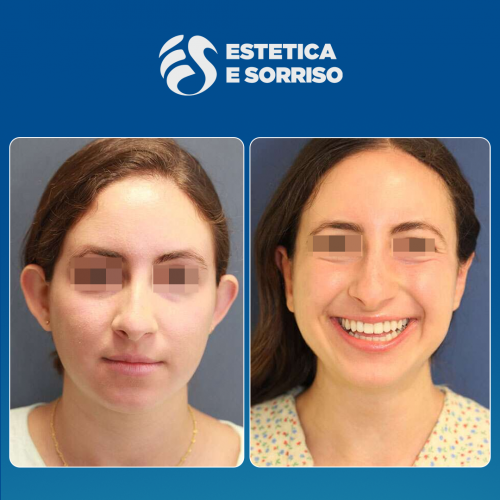 Estetica e Sorriso - Otoplastica (Gallery)