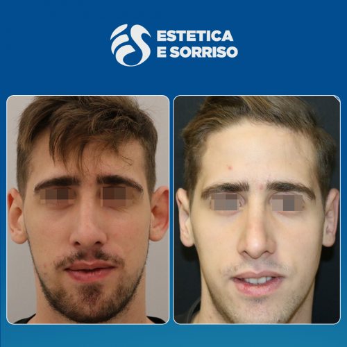 Estetica e Sorriso - Otoplastica (Gallery)