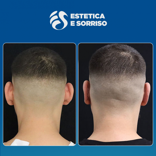 Estetica e Sorriso - Otoplastica (Gallery)