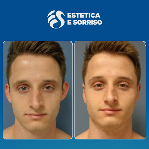 Estetica e Sorriso - Otoplastica (Gallery)