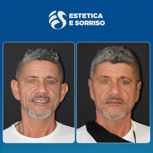 Estetica e Sorriso - Otoplastica (Gallery)