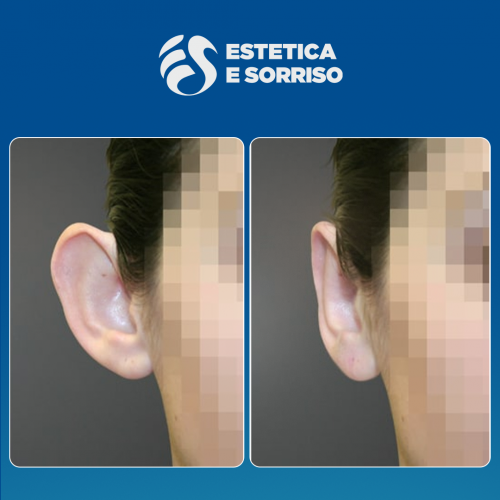 Estetica e Sorriso - Otoplastica (Gallery)