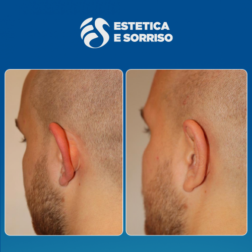 Estetica e Sorriso - Otoplastica (Gallery)