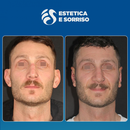 Estetica e Sorriso - Otoplastica (Gallery)