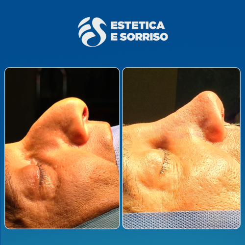 Rhinoplasty 1 copy 2