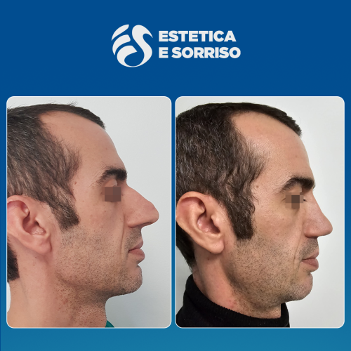 Rhinoplasty 1 copy 3