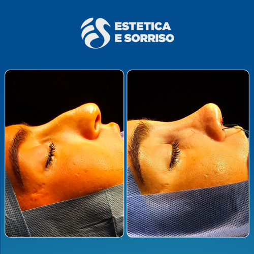 Rhinoplasty 1 copy 4
