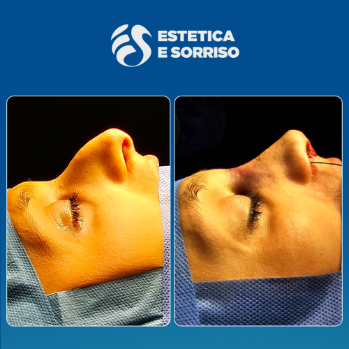 Rhinoplasty 1 copy 5