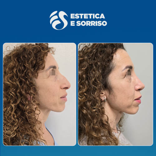 Rhinoplasty 1 copy 6