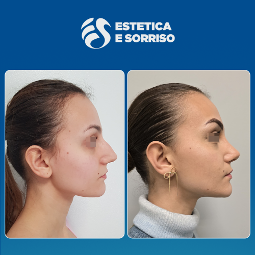 Rhinoplasty 1 copy 7