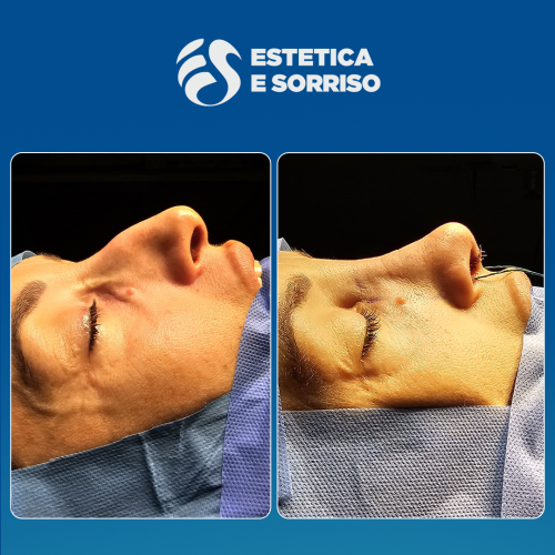 Rhinoplasty 1 copy 8