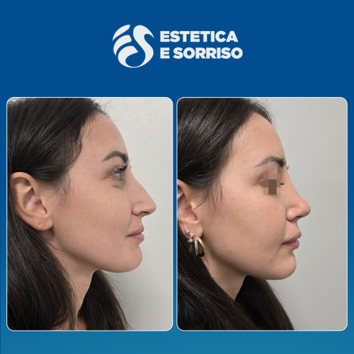 Rhinoplasty 1 copy 9