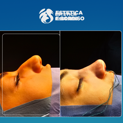 Rhinoplasty 1 copy