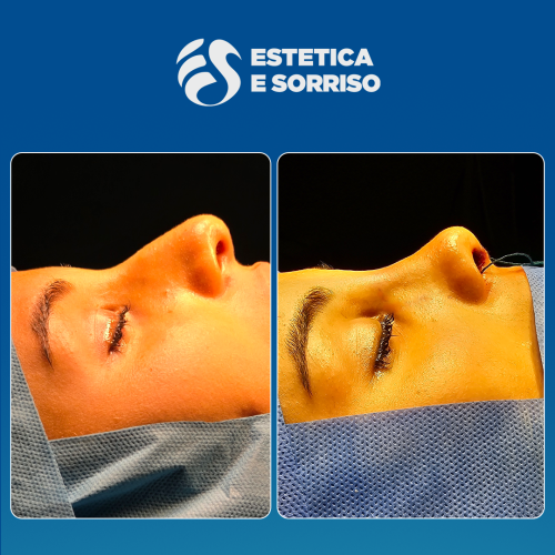 Rhinoplasty 1